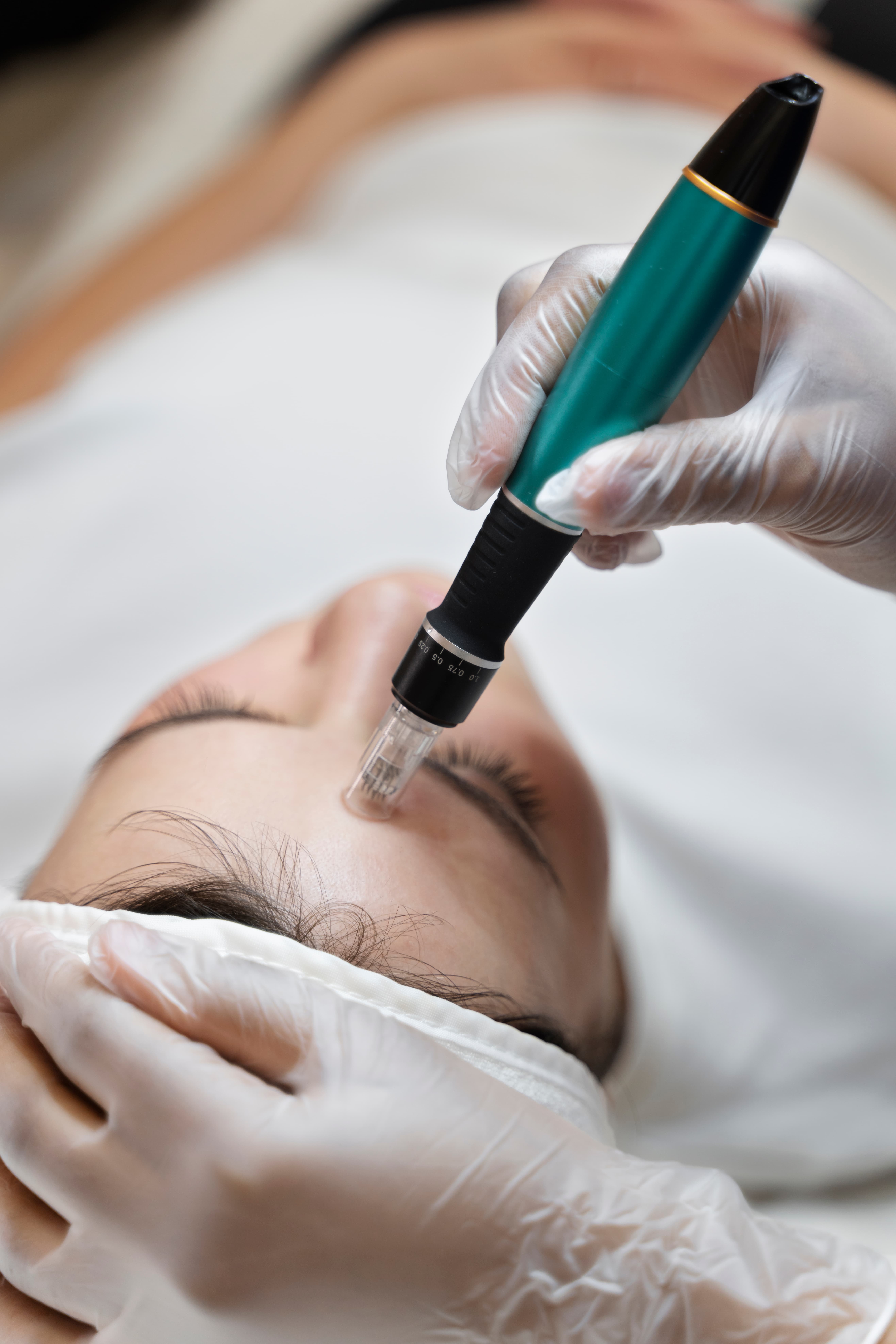 person getting micro needling beauty treatment 3 1 Micro-needling in Louisville